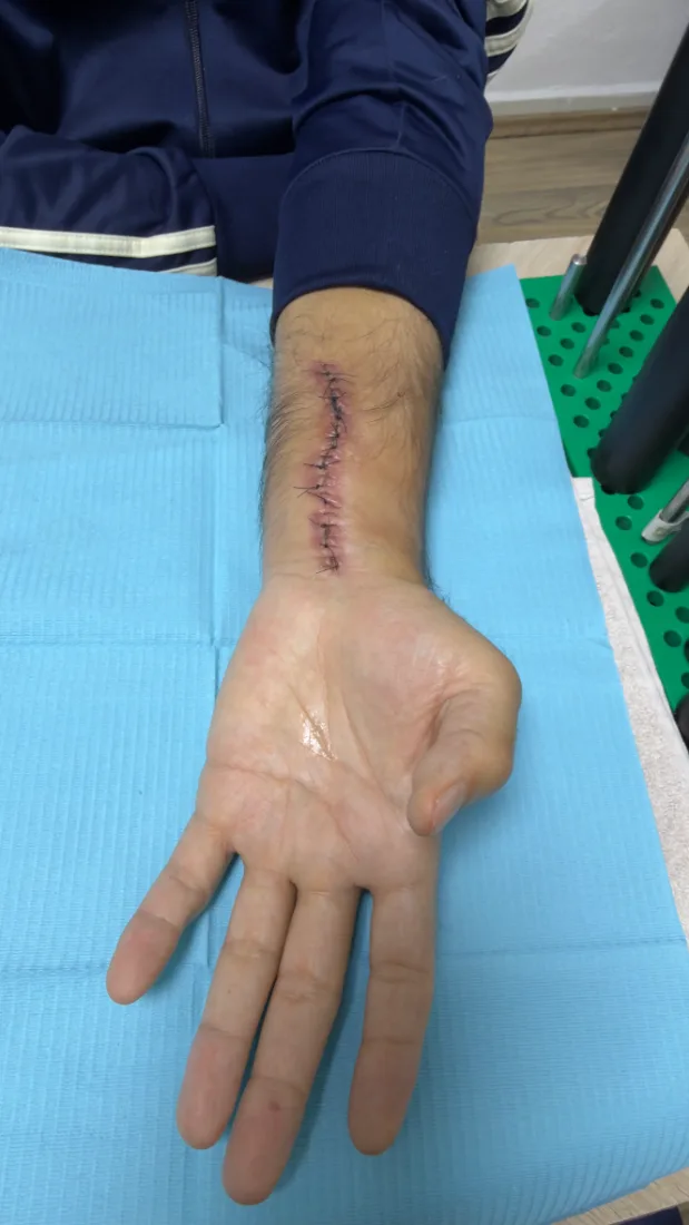 Cicatriz post-quirúrgica de muñeca en seguimiento de rehabilitación en RehabiliTO