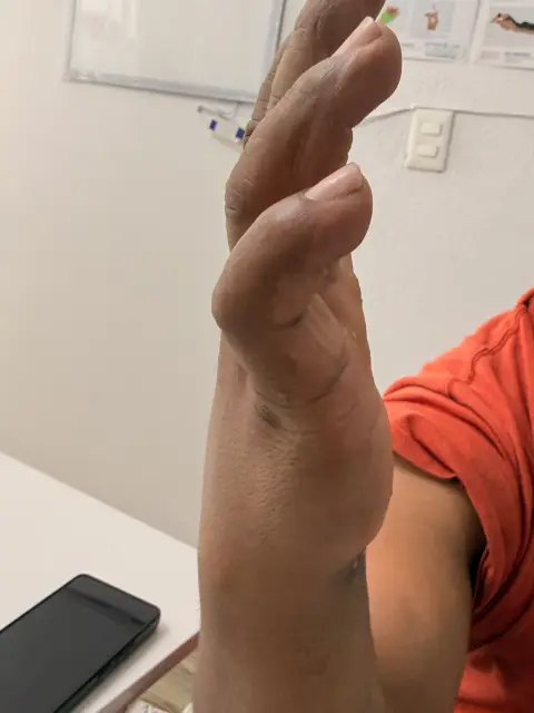 Paciente recuperando la movilidad del pulgar y la mano en RehabiliTO